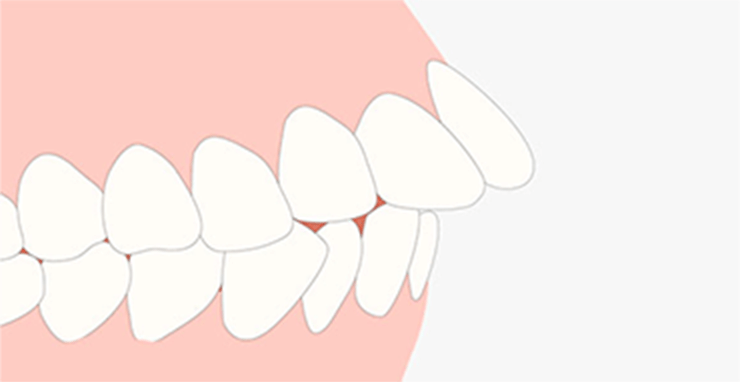上顎前突