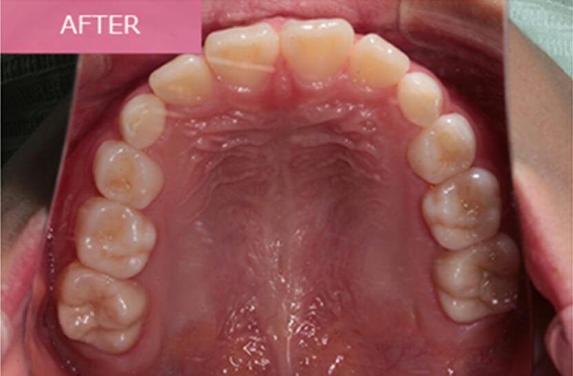 After 小学生の矯正治療 症例02-04