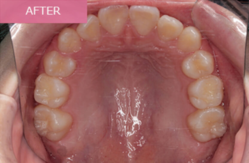 After 小学生の矯正治療 症例03-04