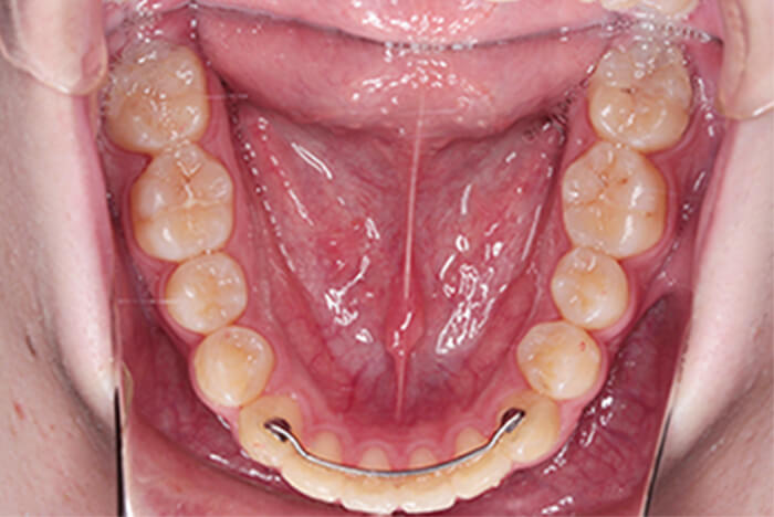After 中学生・高校生の矯正治療 症例02-01