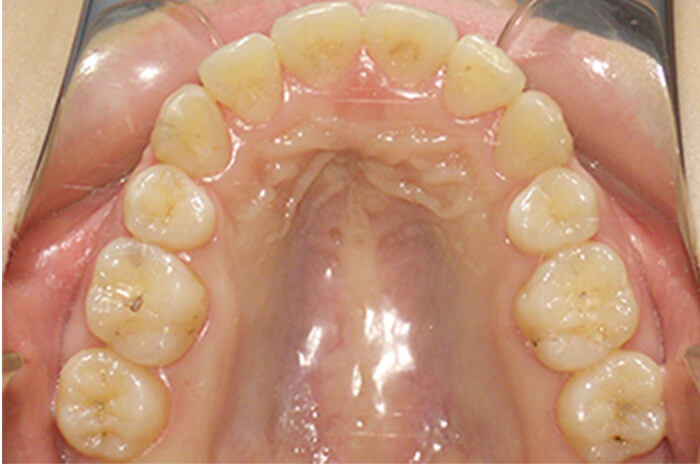 After 成人の矯正治療 症例02-01