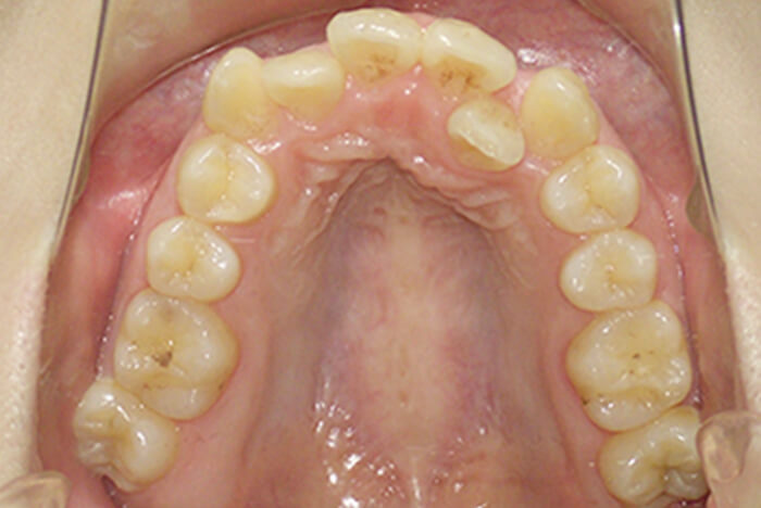 Before 成人の矯正治療 症例02-01