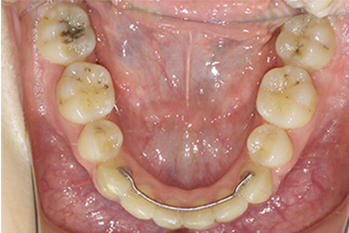 After 成人の矯正治療 症例02-01