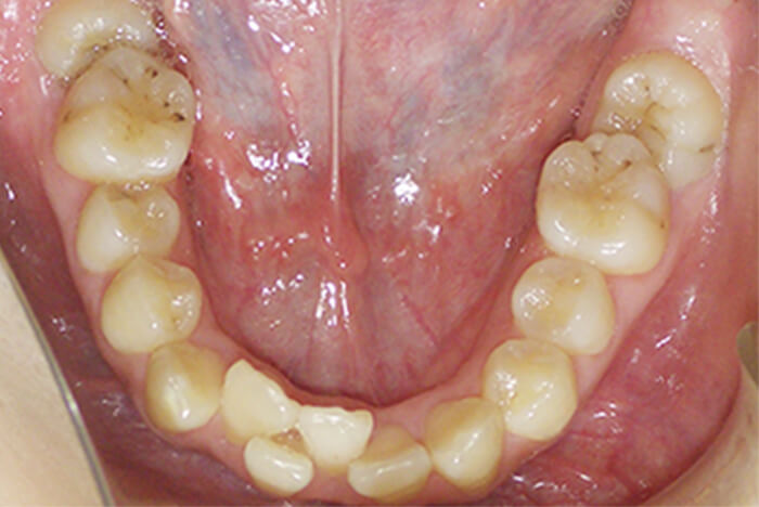 Before 成人の矯正治療 症例02-01