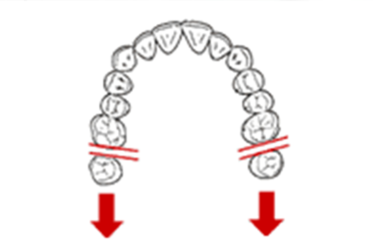 奥歯を移動する