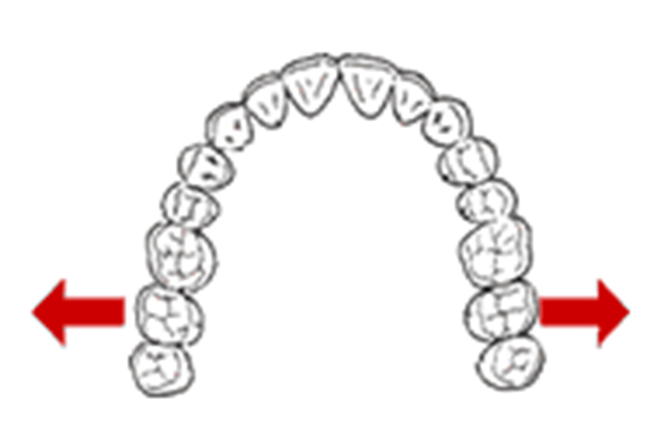 歯列を側方拡大する